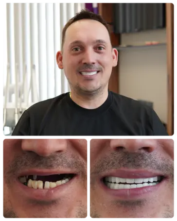 Full mouth Implants transformation — Romanian